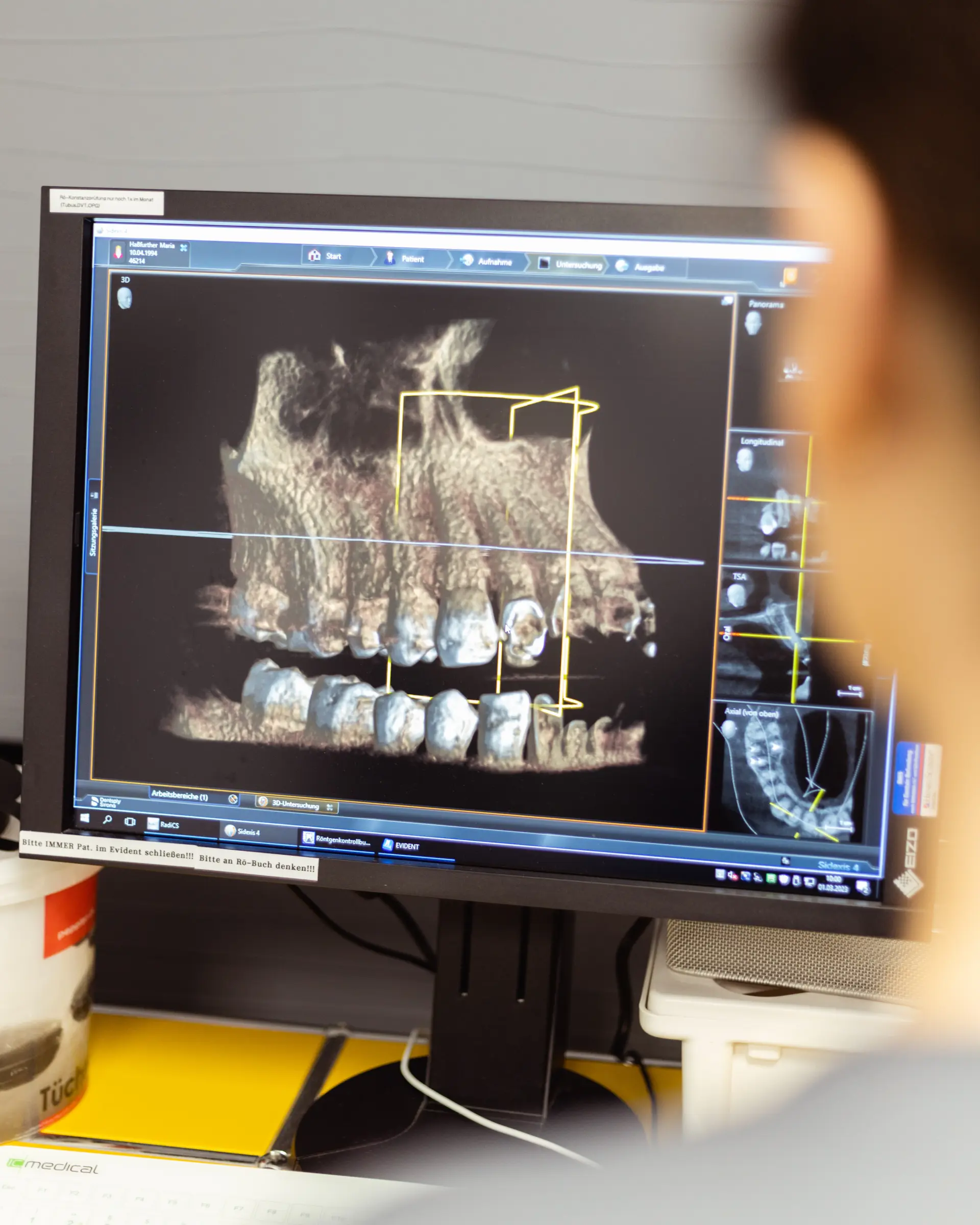 3D-Röntgenaufnahme eines Kiefers zur digitalen Implantatplanung